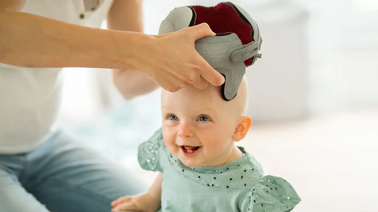 Plagiocephaly
